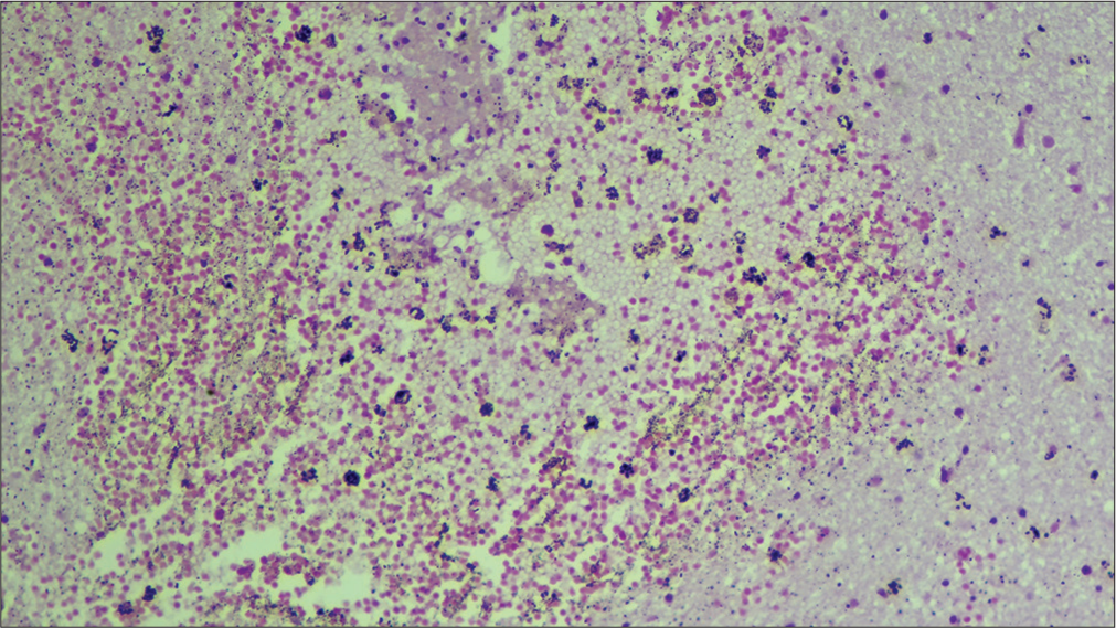 Brain parenchymal hemorrhage (10X, Hematoxylin and eosin stain).