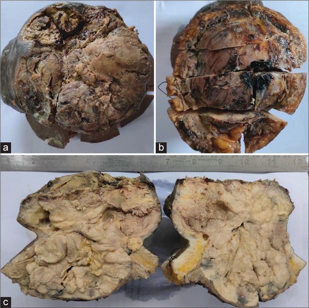 (a) Gross picture of the lesion showing exophytic mass with ulcerated overlying skin, (b) a fibrofatty base and (c)a fleshy tumor on cut.