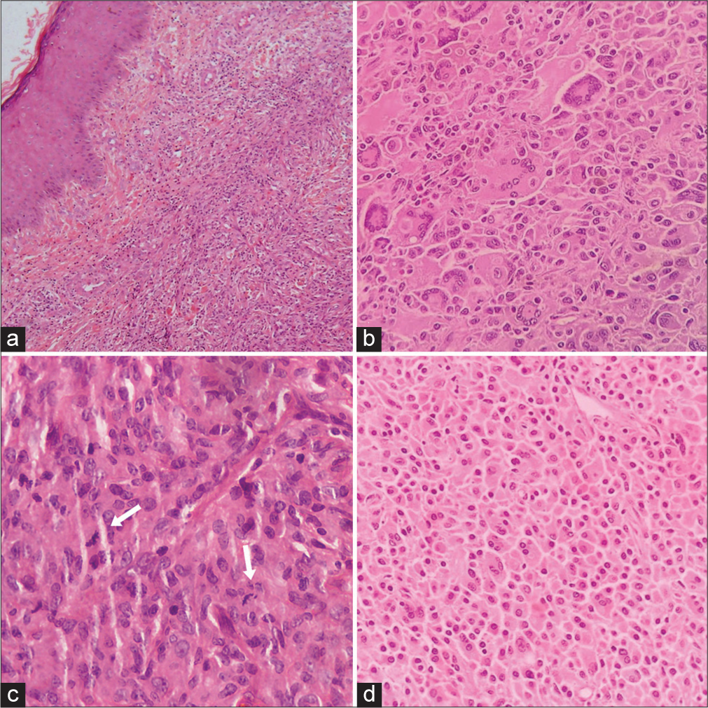 Hematoxylin and Eosin (H&E)-stained section from the tumor in the dermis extending to subcutis. (b) Numerous Touton giant cells, histiocytes with abundant cytoplasm, some showing emperipolesis, scattered eosinophils, lymphocytes and plasma cells. (c) Mitotically active tumor (white arrows) (d) Sheets of histiocytes with abundant cytoplasm, however typical foamy cytoplasm not seen.