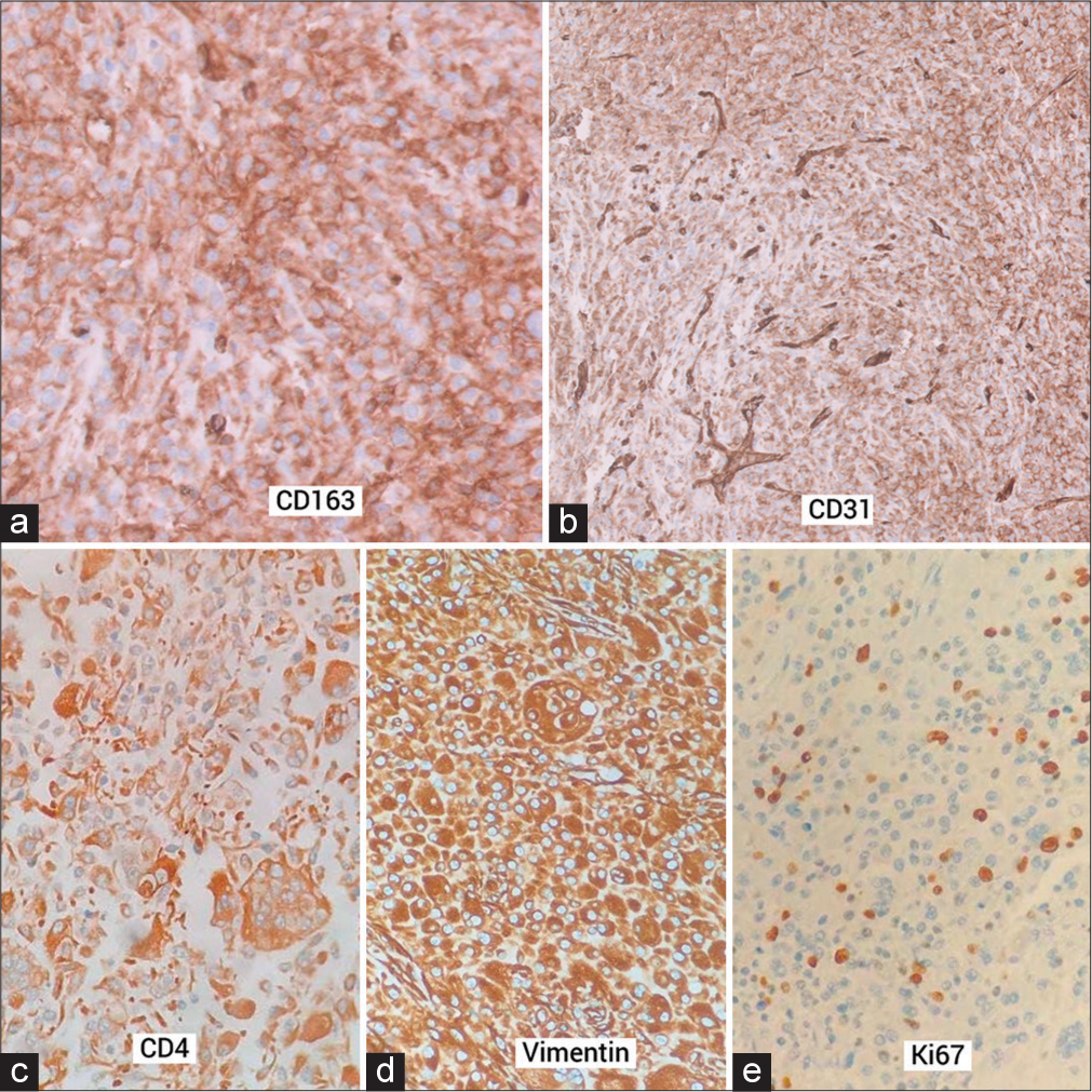 Immunohistochemistry showed the lesional cells expressing (a) CD163, (b) weak CD31, note the blood vessels taking strong staining (c) CD4, and (d) Vimentin (e) Ki67 expression was high (30 to 40%).