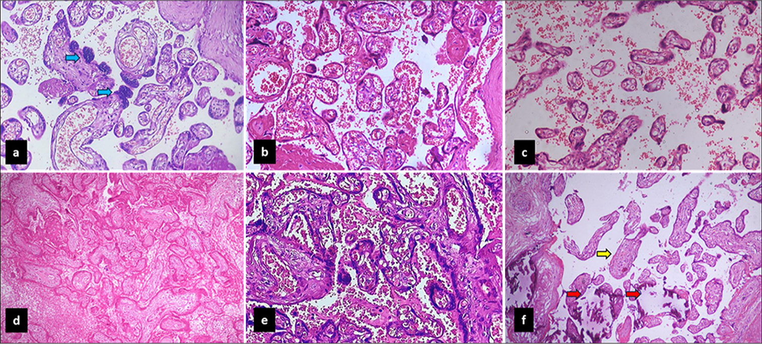 Photomicrographs of H&E sections from placenta showing a- prominent syncytial knots (blue arrow) (400x), (b) chorangiosis (200x), (c) decreased number and vascularity of villi (200x), (d) infarct (100x), (e) prominent syncytial knots and intervillous hemorrhage (200x), (f) fibrotic villi and calcification (yellow arrow, black arrow) (200x).