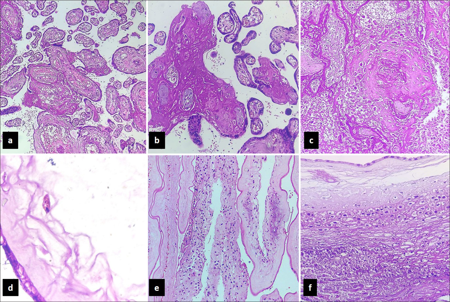 Photomicrographs of H&E sections from placenta showing (a and b) fibrotic villi with perivillous fibrin (200x and 400x), (c) infarct (200x), (d)-meconium macrophage (400x) and (e) and f-chorioamnionitis (200x and 400x).