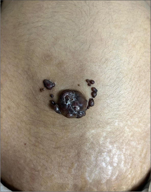 Clinical image showed multiple brownish-black nodules with satellite nodules around the umbilicus.