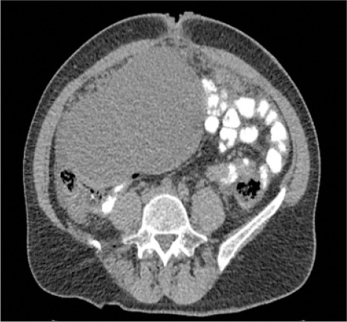 Contrast-enhanced magnetic resonance imaging of the abdominal cavity and pelvis showed an expansive tumorous formation covering the uterus with carcinomatosis of the peritoneum (transversal view).