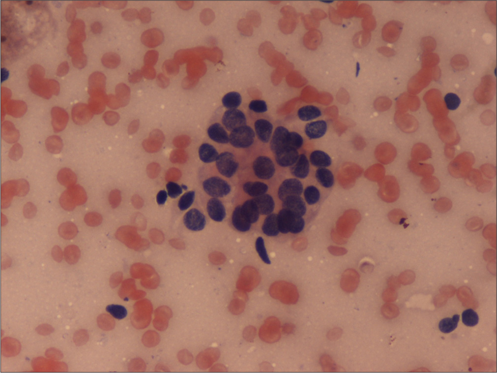 Fine needle aspiration cytology was suggestive of metastatic malignancy. Hematoxylin and eosin ×40.