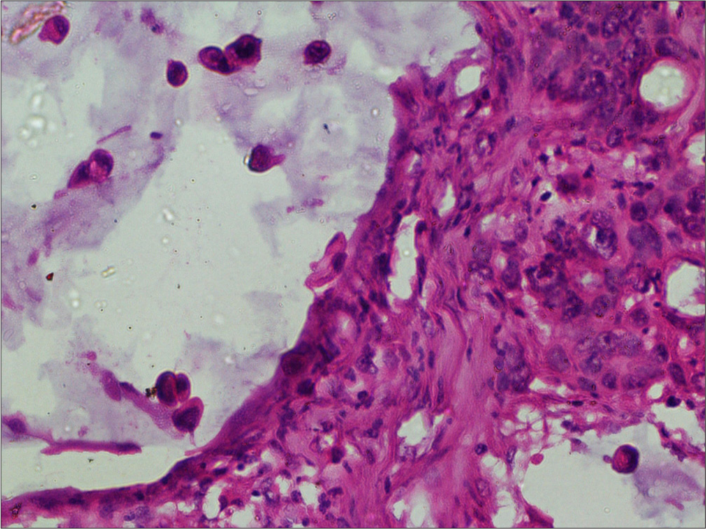 The histopathology was suggestive of adenocarcinoma infiltrating the underlying dermis with occasional signet cells. Hematoxylin and eosin ×40.