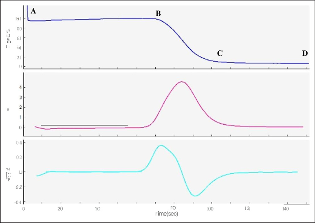 APTT clot waveform, prolonged pre coagulation pattern–65 yr-old male diagnosed with septicaemia, APTT 40 secs (prolonged). Transmittance wave (top most graph) showed markedly prolonged pre coagulation phase (A-B), a normal coagulation phase (B-C) and post coagulation phase (C-D). Blue graph - Transmittance wave form, Purple graph-First derivative curve, Green graph- Second derivative curve.