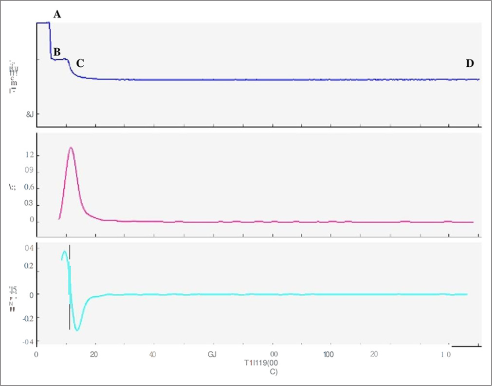 APTT clot waveform- Biphasic wave pattern – 60 yrs-old male patient had hematuria with decreased platelet count, decreased fibrinogen, increased D-dimer and a normal APTT (32 sec). Even with normal APTT, the transmittance wave (top most graph) showed the initial plateau phase (A-B) before the commencement of the clot formation was replaced by a slope, the coagulation and the post coagulation phases are similar to a normal CW (biphasic wave pattern).Blue graph - Transmittance wave form, Purple graph-First derivative curve, Green graph- Second derivative curve