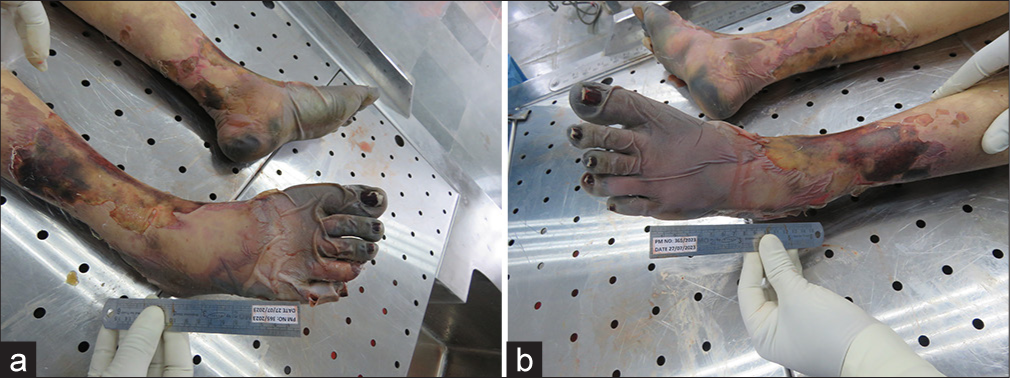 (a and b) Blackish discoloration of both the hands.