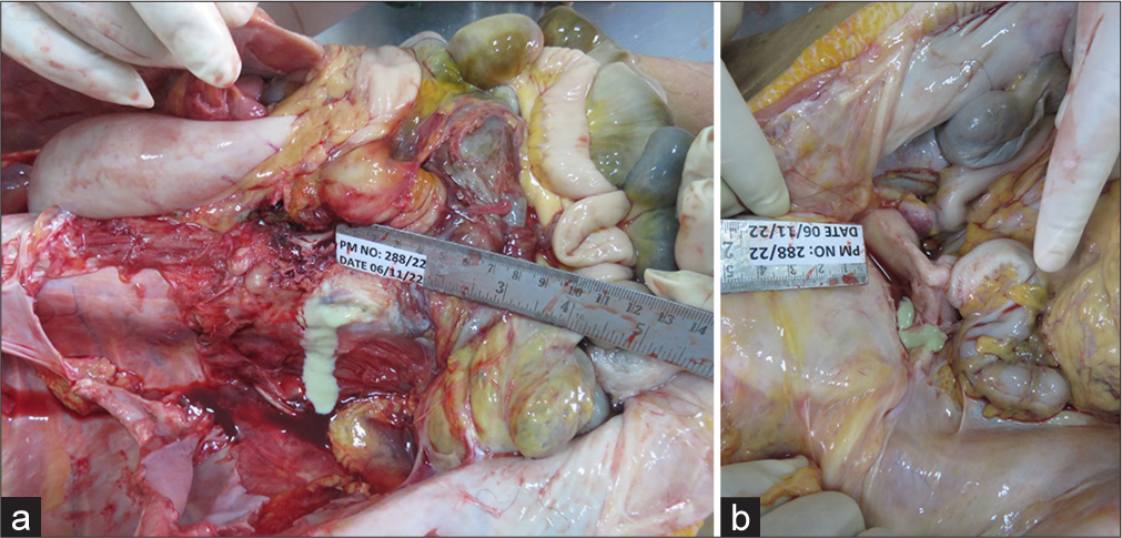 (a and b) Abscess of psoas muscle and paravertebral muscles.